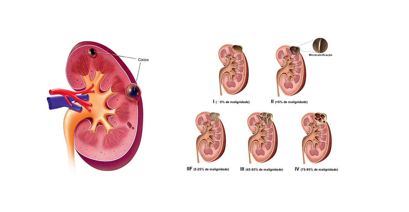 Cisto no rim pode ser câncer? - Bestane Urologia